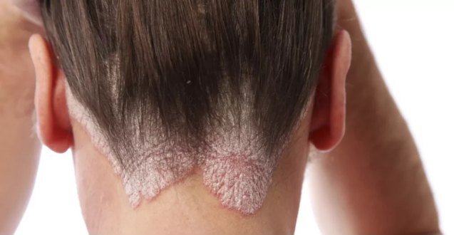Imagen de la nota de El Día sobre psoriasis capilar.
